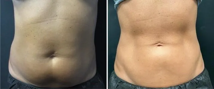 Före och efter Insculpt, midsection