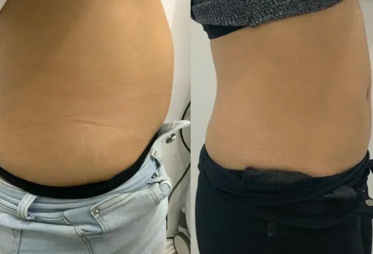 Före och efter Insculpt, sidovy
